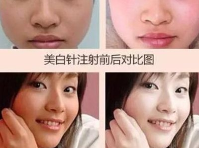 如何打美白针（如何打美白针需要注意什么）