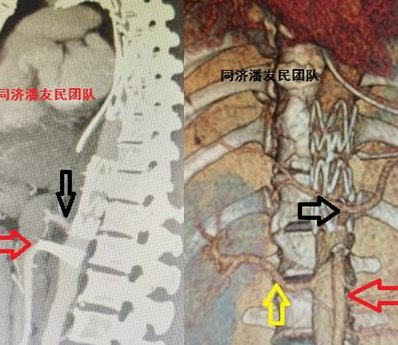 谷道破裂是什么意思(谷道破裂导致的主要问题是什么？)