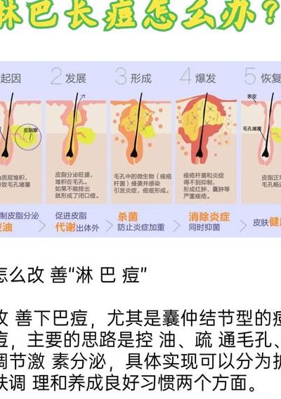 淋巴痘腮边痘怎么去除（脸颊腮边两侧长痘痘什么原因）